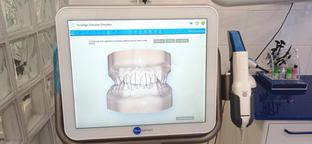 scanner iTero invisalign ortodonzia invisibile